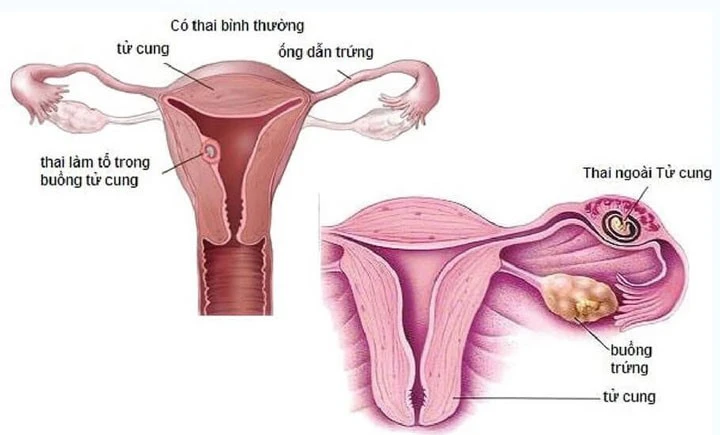 Người phụ nữ tự phá thai tại nhà mà không biết mình đã mang thai ngoài tử cung. (Ảnh minh họa) phá thai tại nhà.jpg