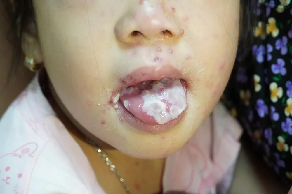 nhiễm trùng do thủy đậu.jpg