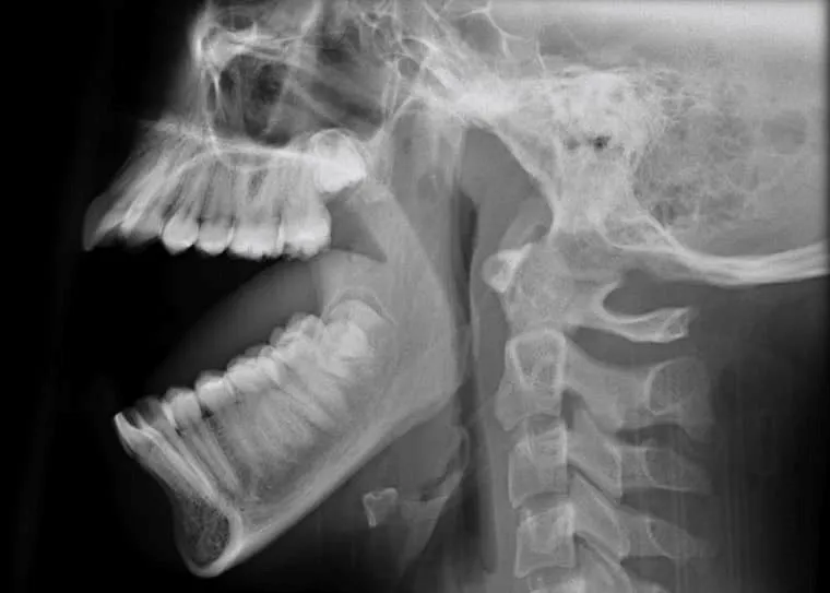 trật khớp hàm.jpg