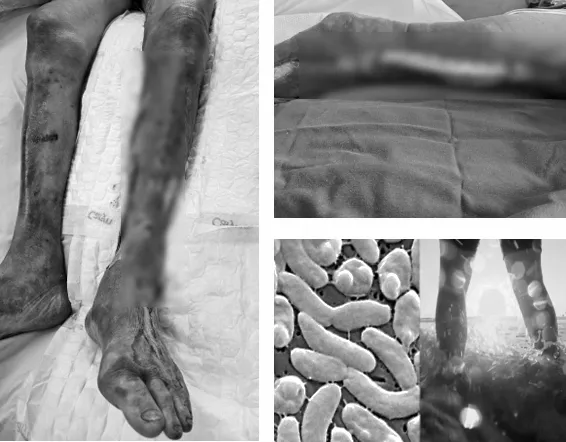 Người đàn ông nhập viện trong tình trạng nguy kịch sau khi nhiễm vi khuẩn ăn thịt người vibrio vulnificus. Ảnh: BVCC vi khuẩn ăn thịt người