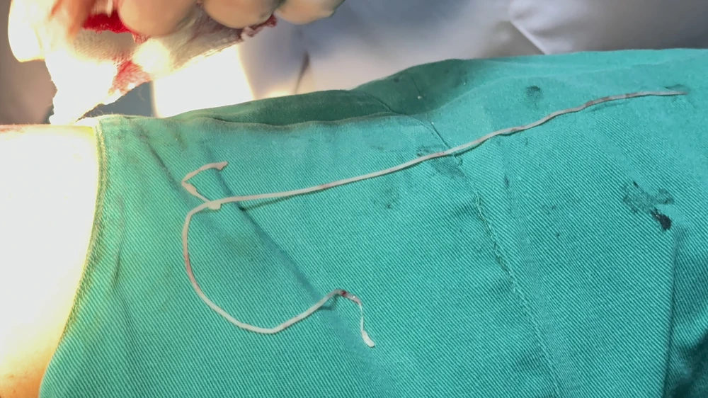 giun ký sinh trùng.jpg