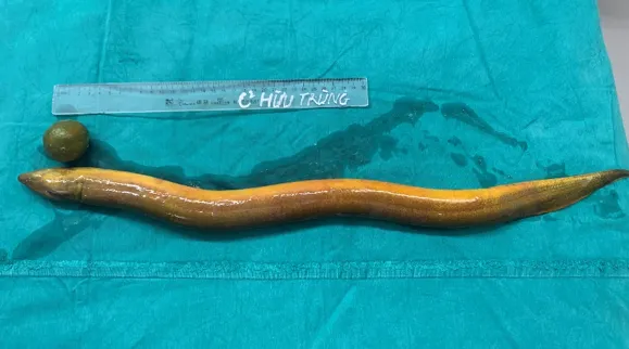 Nam thanh niên người Ấn Độ suýt mất mạng vì nhét con lươn 65 cm vào hậu môn. Ảnh: BVCC nhét con lươn 65 cm vào hậu môn.png