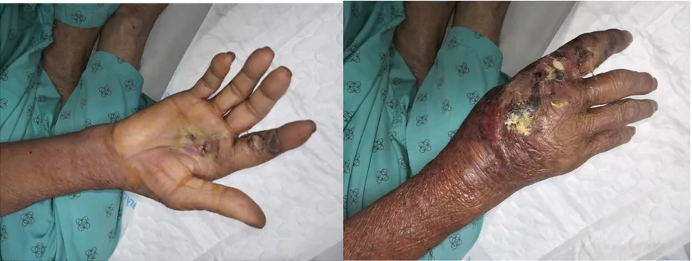 Tình trạng vết thương của bệnh nhân sau 10 ngày điều trị do bị chó nhà cắn. Ảnh: BVCC chó nhà cắn 1.jpg