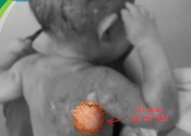 Vết bỏng của trẻ nặng hơn sau khi được thầy lang bôi mỡ trăn. Ảnh: BVCC bị bỏng bôi mỡ trăn.jpg