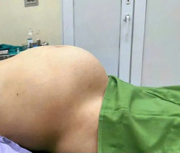 u buồng trứng to như thai 8 tháng