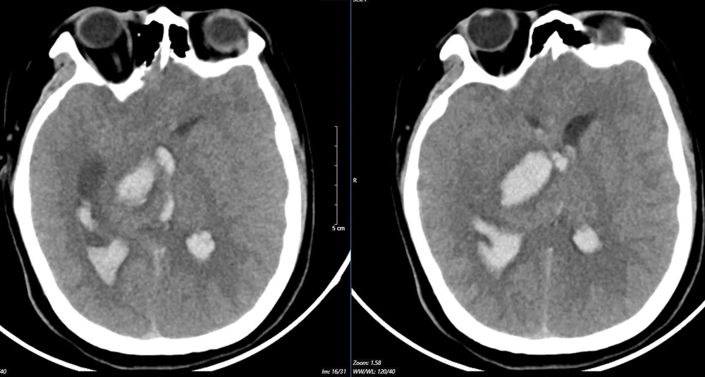 dị dạng mạch máu não