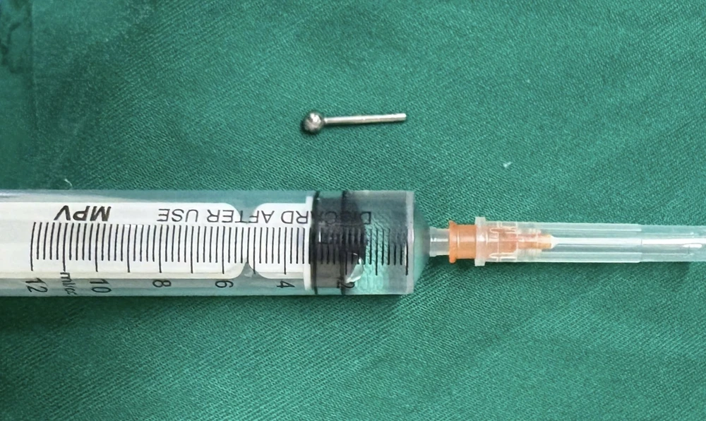 Khuyên đeo ở lưỡi rơi xuống dạ dày