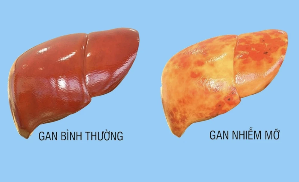 Gan nhiễm mỡ là tình trạng lượng mỡ trong gan tích tụ quá mức, chiếm trên 5% trọng lượng gan. Ảnh minh hoạ gan nhiễm mỡ