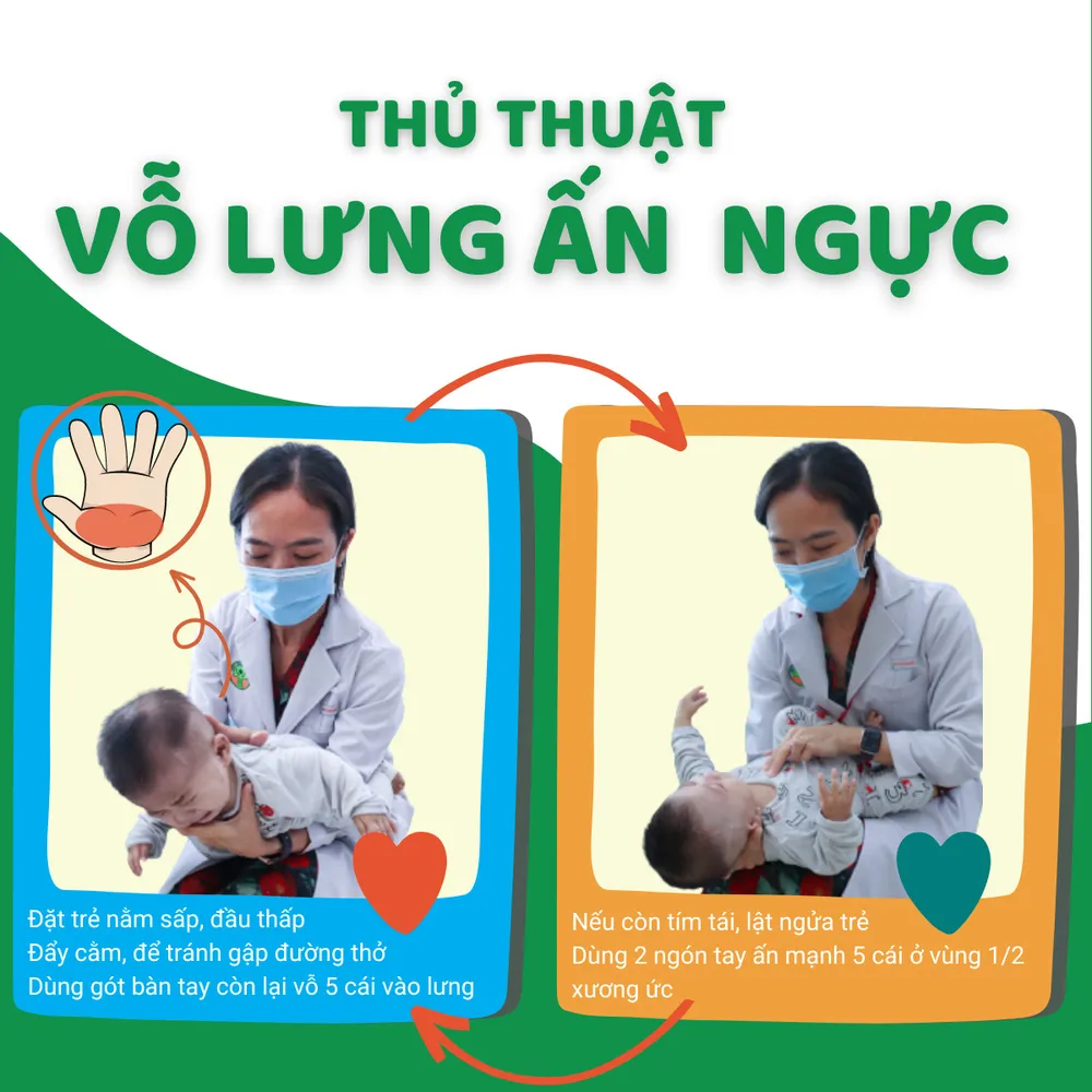 Các thao tác vỗ lưng ấn ngực đối với trẻ dưới hai tuổi. Ảnh: Bệnh viện Nhi Đồng 2, TP.HCM hóc hạt dưa