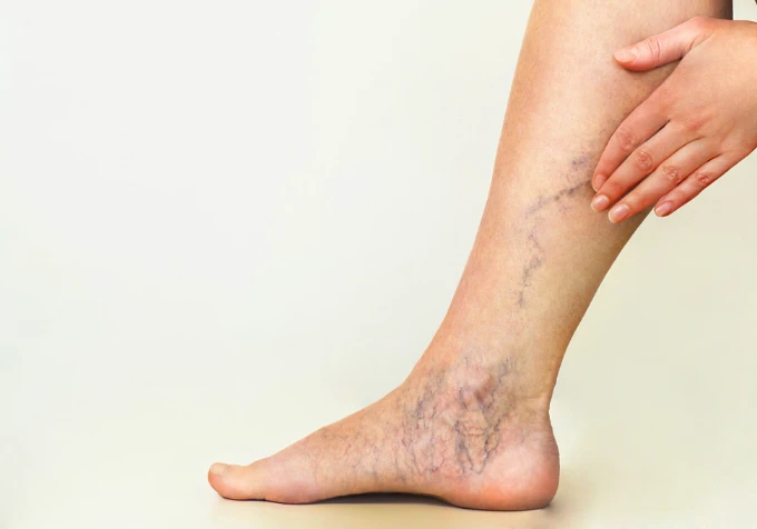 Chân bệnh nhân bị suy giãn tĩnh mạch. Ảnh minh họa suy giãn tĩnh mạch