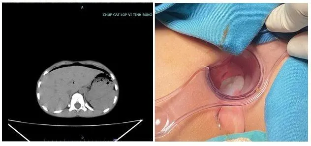 Chiếc bút đâm vào tầng sinh môn, xuyên thủng trực tràng vào trong ổ bụng bệnh nhi. Ảnh: BVCC thung-truc-trang-9113-4641.jpg.webp