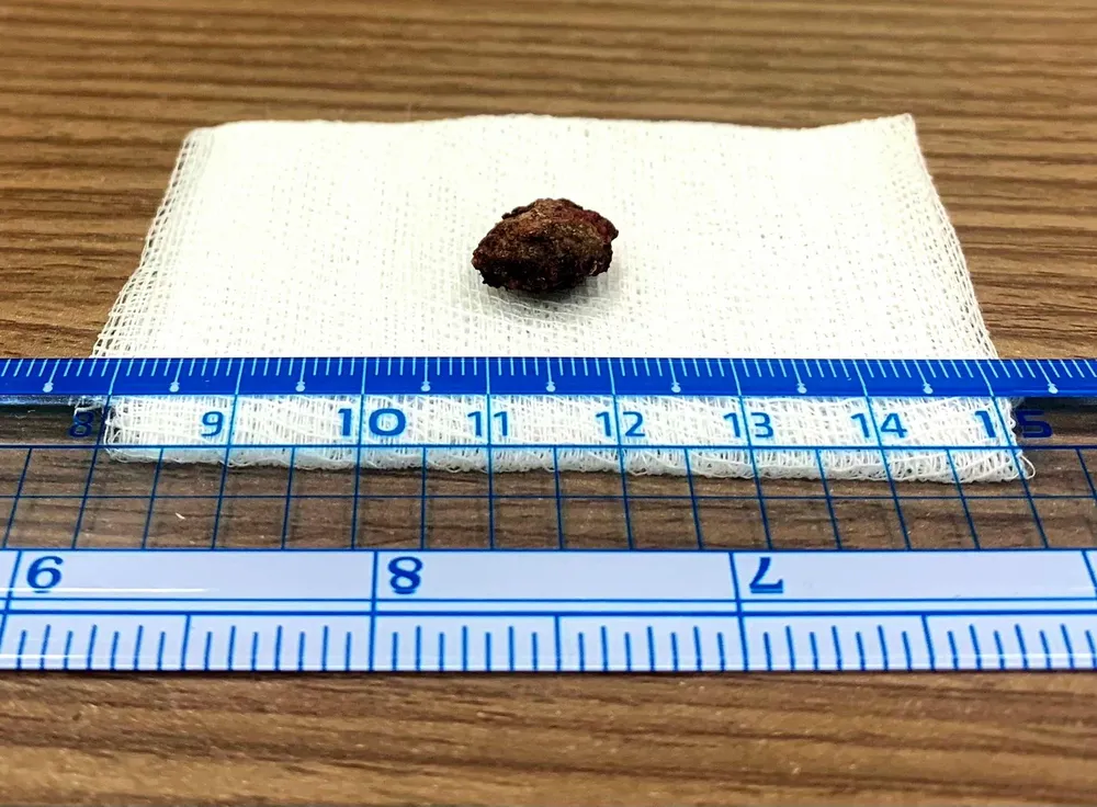 Viên sỏi được lấy ra từ hốc mũi của bệnh nhân. Ảnh VH.