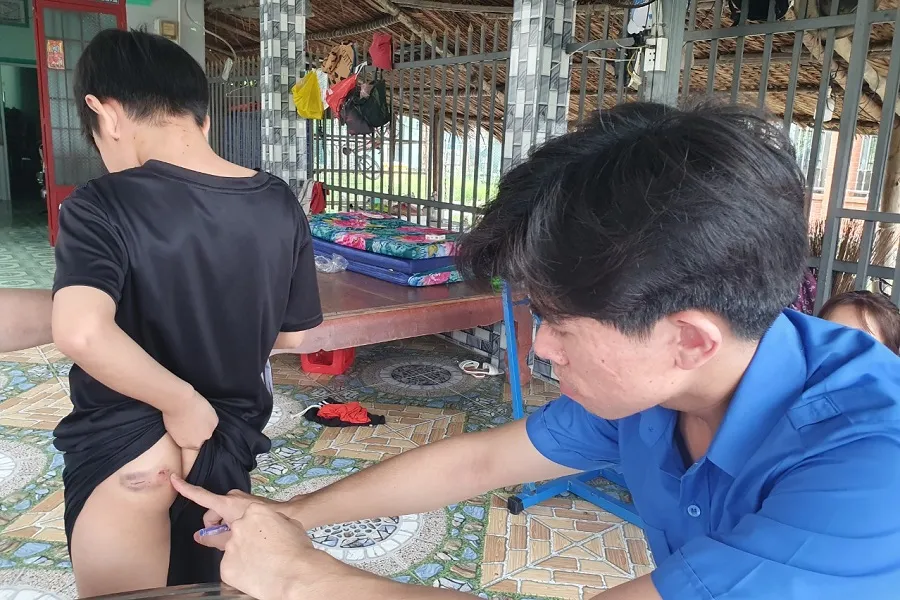 Một trong 5 người bị chó có virus dại cắn tại huyện Nhơn Trạch. Ảnh: HAC.