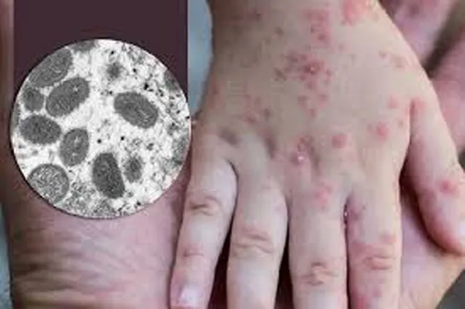 Một trong những biểu hiện của bệnh đậu mùa khỉ là phát ban. (Ảnh minh họa) bệnh- đậu - khỉ.jpg