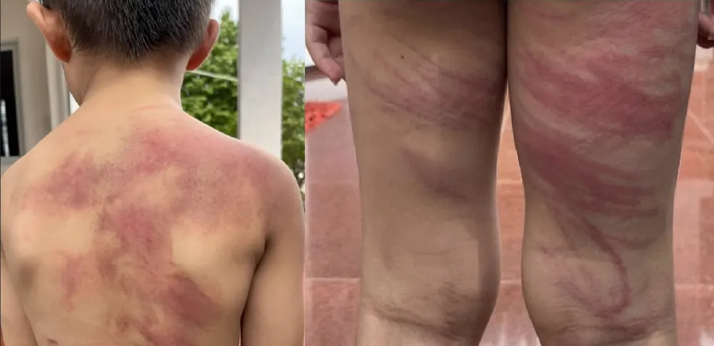 Cháu Đ bị cha ruột đánh thâm tím cơ thể. Ảnh: CA. Bé trai 5 tuổi ở Đồng Nai bị cha ruột đánh dã man