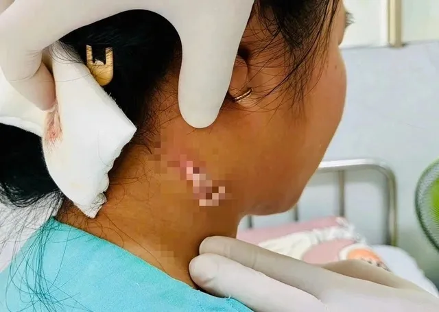 nhiễm vi khuẩn.jpg