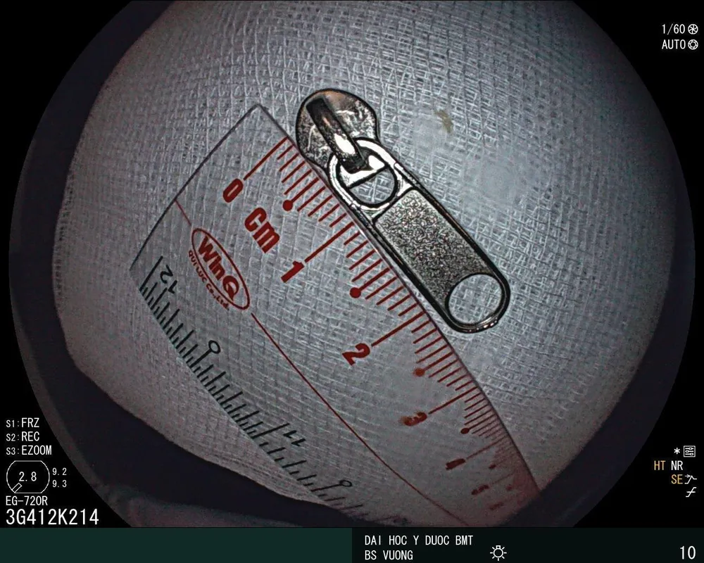 Khóa kéo bên trong dạ dày bé trai 6 tuổi Khóa kéo bên trong dạ dày bé trai 6 tuổi