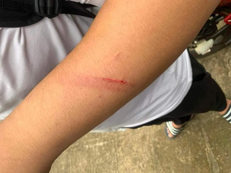 Một em học sinh bị đánh thương tích ở tay. Ảnh: CTV