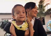 Em bé vừa sinh ra đã nghi mắc bệnh xương thủy tinh ảnh 2 “Có bé chỉ nằm một chỗ hắt xì cũng gãy xương…”