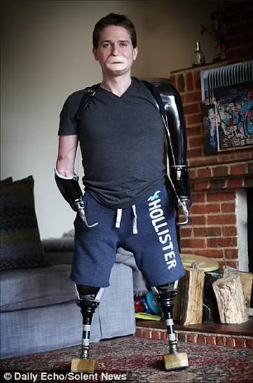 Sức mạnh của người đàn ông bị vi khuẩn ăn 4 chi ảnh 1 Sức mạnh của người đàn ông bị vi khuẩn ăn 4 chi ảnh 1