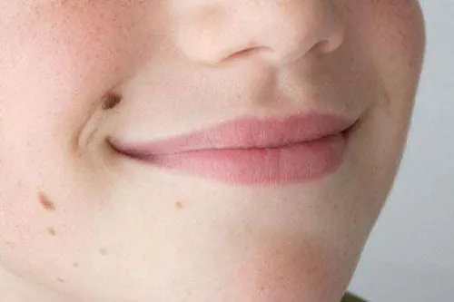 Nốt ruồi như thế nào thì nên đi khám? ảnh 1