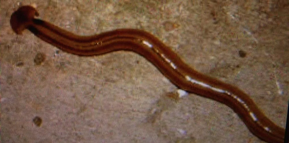 Rùng mình: 20 dạng vật lạ trong cơ thể người ảnh 19