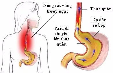 Tại sao bệnh dạ dày hay tái phát vào mùa thu? ảnh 1 dấu hiệu của bệnh dạ dày