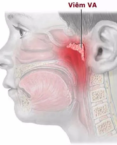 Những điều cần biết về viêm VA ảnh 1 viêm VA