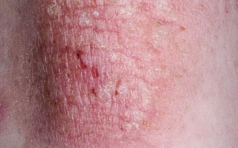 bệnh eczema gây ngứa