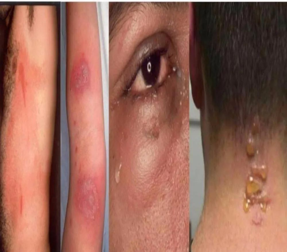 bị kiến ba khoang cắn