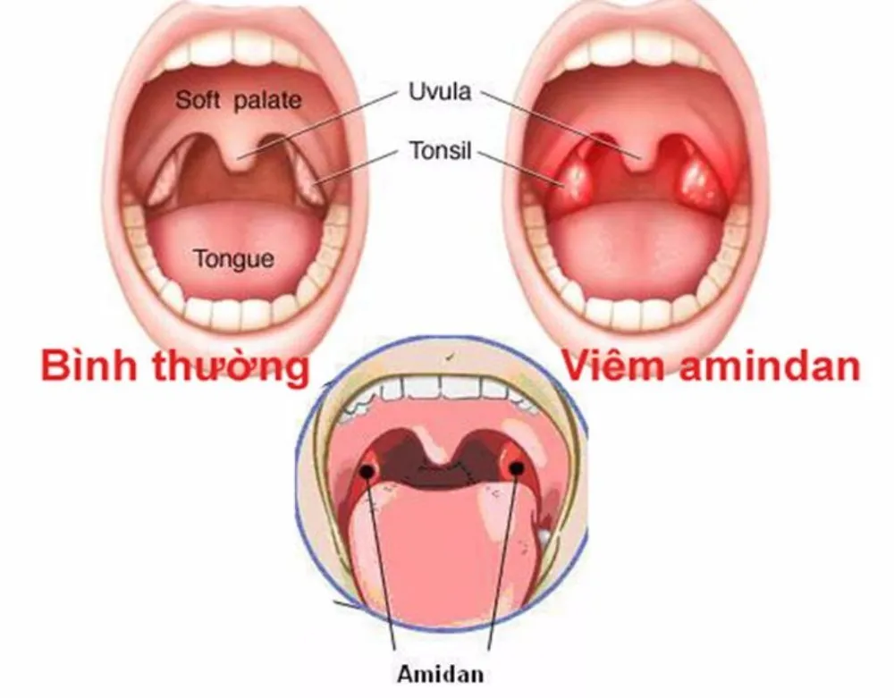 amidan bình thường và amidan bị viêm