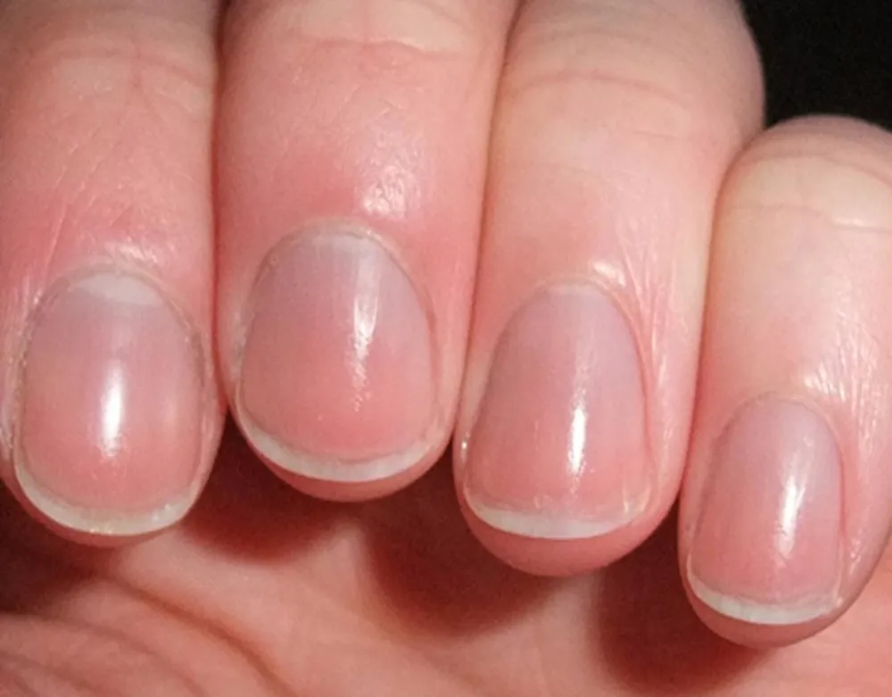 Nếu móng tay nửa trắng nửa nâu hoặc màu tối, nên sớm đi khám bác sĩ.