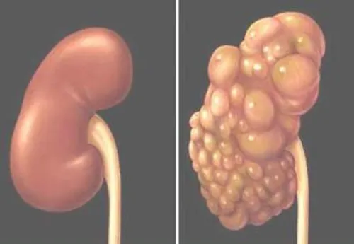 Bệnh thận đa nang và các biến chứng ảnh 1