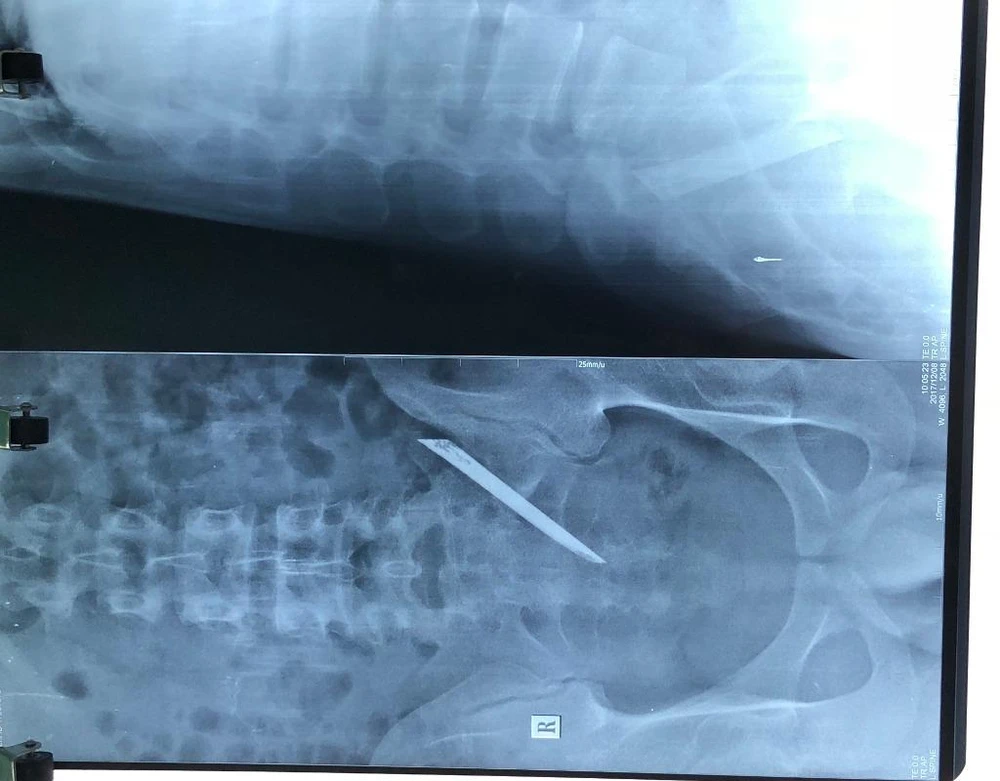 Phim chụp cho thấy có dị vật trong cơ thể bệnh nhân