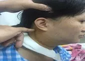 Cô gái suýt câm vì bác sĩ nhầm khối u là hạch cổ