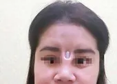Bị thanh silicon đâm thủng mũi chòi ra giữa mặt