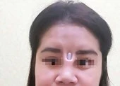 Bị thanh silicon đâm thủng mũi chòi ra giữa mặt