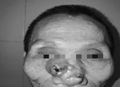 Tái tạo lại mũi, má cho bệnh nhân mắc bệnh ung thư 