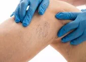 Bí quyết giúp giảm đau do giãn tĩnh mạch chân
