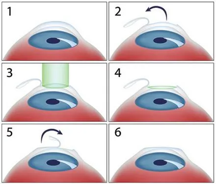 Có nên phẫu thuật chữa cận thị? ảnh 1 Có nên phẫu thuật chữa cận thị? ảnh 1