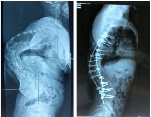Phim chụp xquang trước và sau phẫu thuật nắn chỉnh gù. Ảnh: BV Trung ương Quân đội 108
