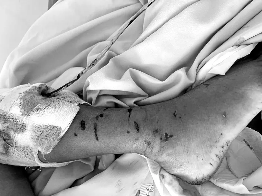 Các vết thương ở chân của bệnh nhân N. do bị chó nhà cắn. Ảnh: Bệnh viện Bà Rịa Các vết thương ở chân của bệnh nhân N. do bị chó nhà cắn. Ảnh: Bệnh viện Bà Rịa