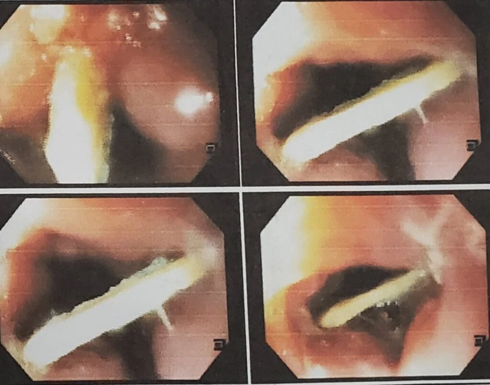 Hình ảnh các dị vật do người bệnh nuốt phải được ghi nhận tại bệnh viện. Ảnh: BỆNH VIỆN NHÂN DÂN GIA ĐỊNH