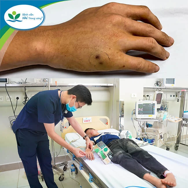 Bé H bị rắn lục cắn khi còn đang điều trị tại BV. Ảnh: BV Nhi Trung ương