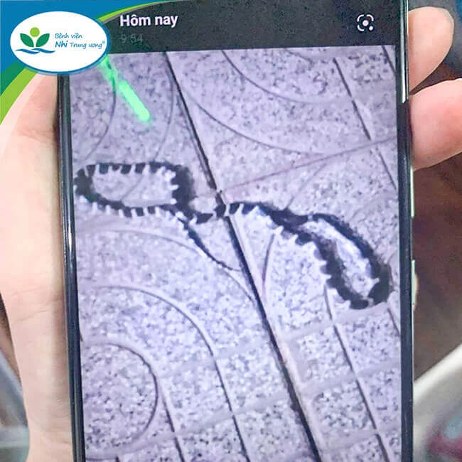 Hình chụp rắn cạp nia cắn bé H do gia đình cung cấp. Ảnh: BV Nhi Trung ương