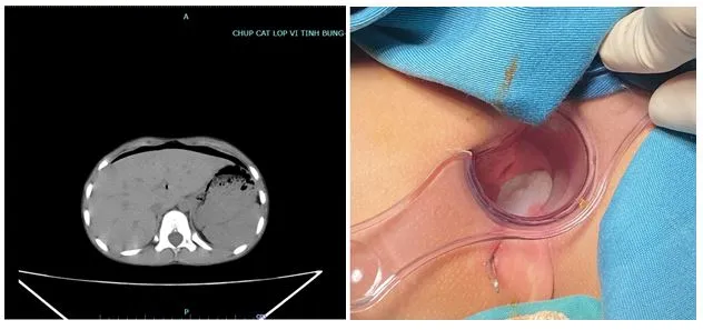 bé trai bị thủng trực tràng
