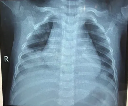 bé trai uống dầu hỏa ngộ độc nguy kịch