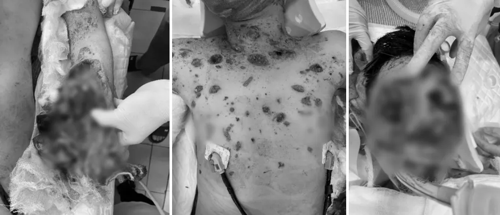 Laptop bất ngờ phát nổ khiến trẻ bị đa chấn thương, chấn thương sọ não