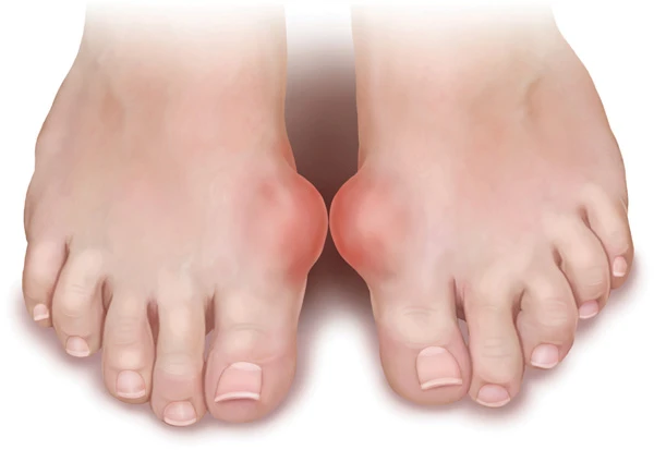Bệnh gút thường khiến người bệnh chịu những cơn đau đột ngột và dữ dội ở các khớp tay, chân, đầu gối... (Ảnh minh họa) bệnh gút