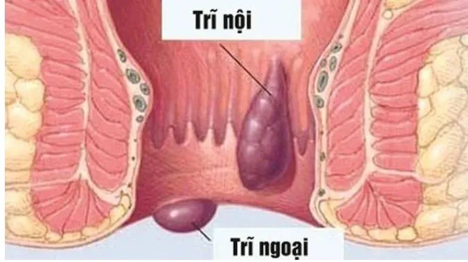 Triệu chứng thường gặp nhất của bệnh trĩ là chảy máu ở vùng hậu môn. (Ảnh minh họa) đi cầu ra máu có phải bị bệnh trĩ